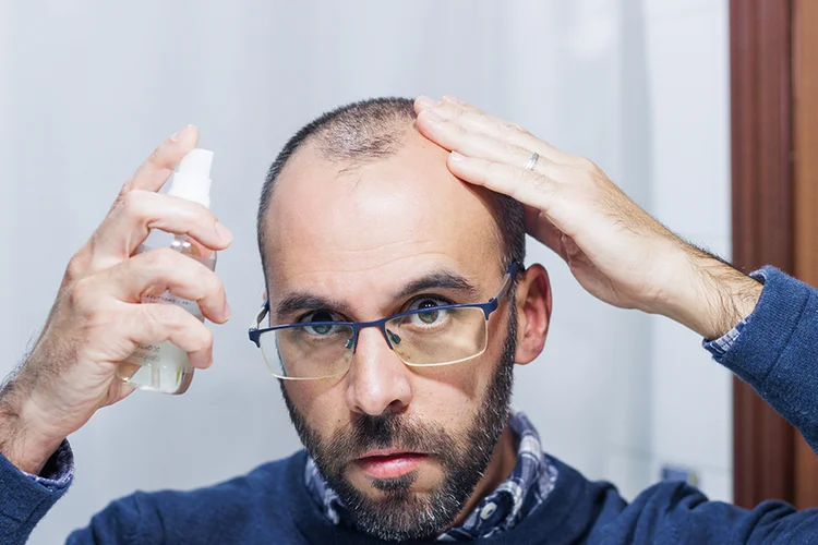 A balding man sprays hair serum onto his scalp.