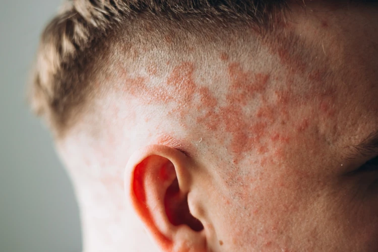Image of a person’s inflamed scalp as a result of psoriasis