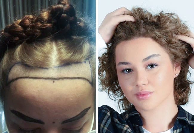 Before and After Eyebrow Transplant of Lilianna Steinhoeffel