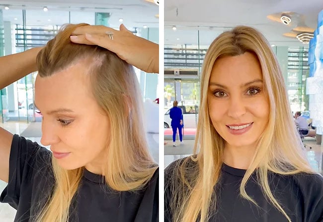 Before and After Hair Transplant for Women