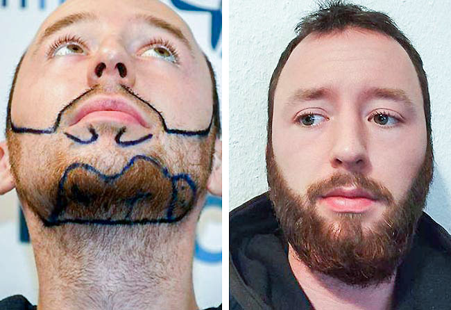 Before and After Sapphire Beard Transplant 3700 Grafts – Felix