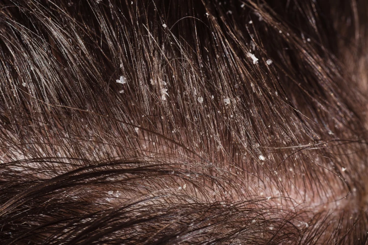A close-up image of dandruff in a man’s hair.