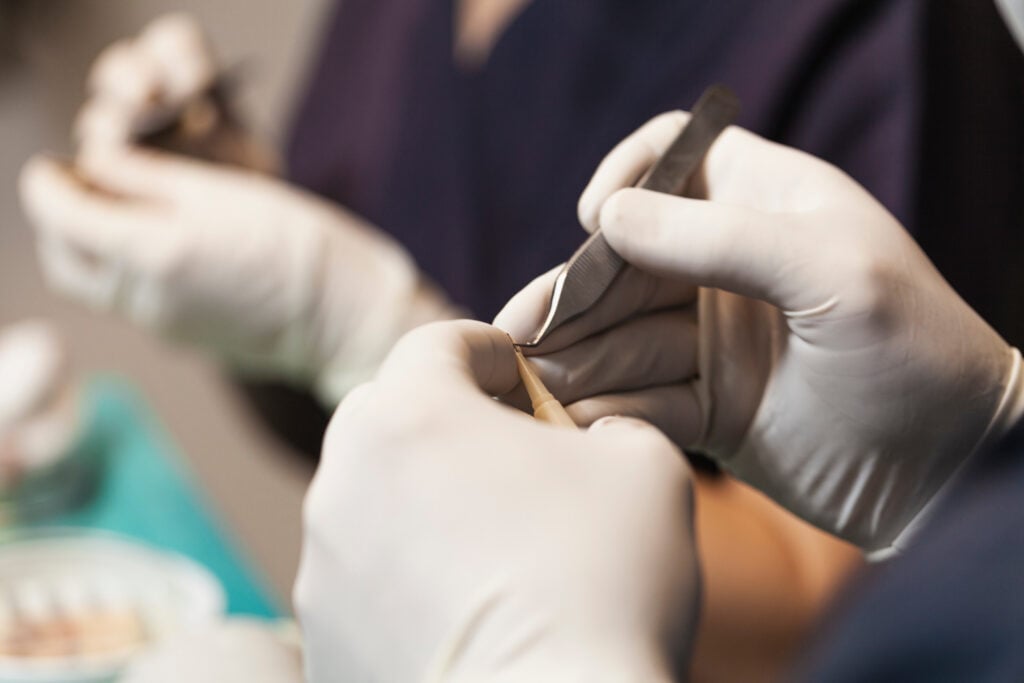 A medical team prepares extracted grafts for implantation.