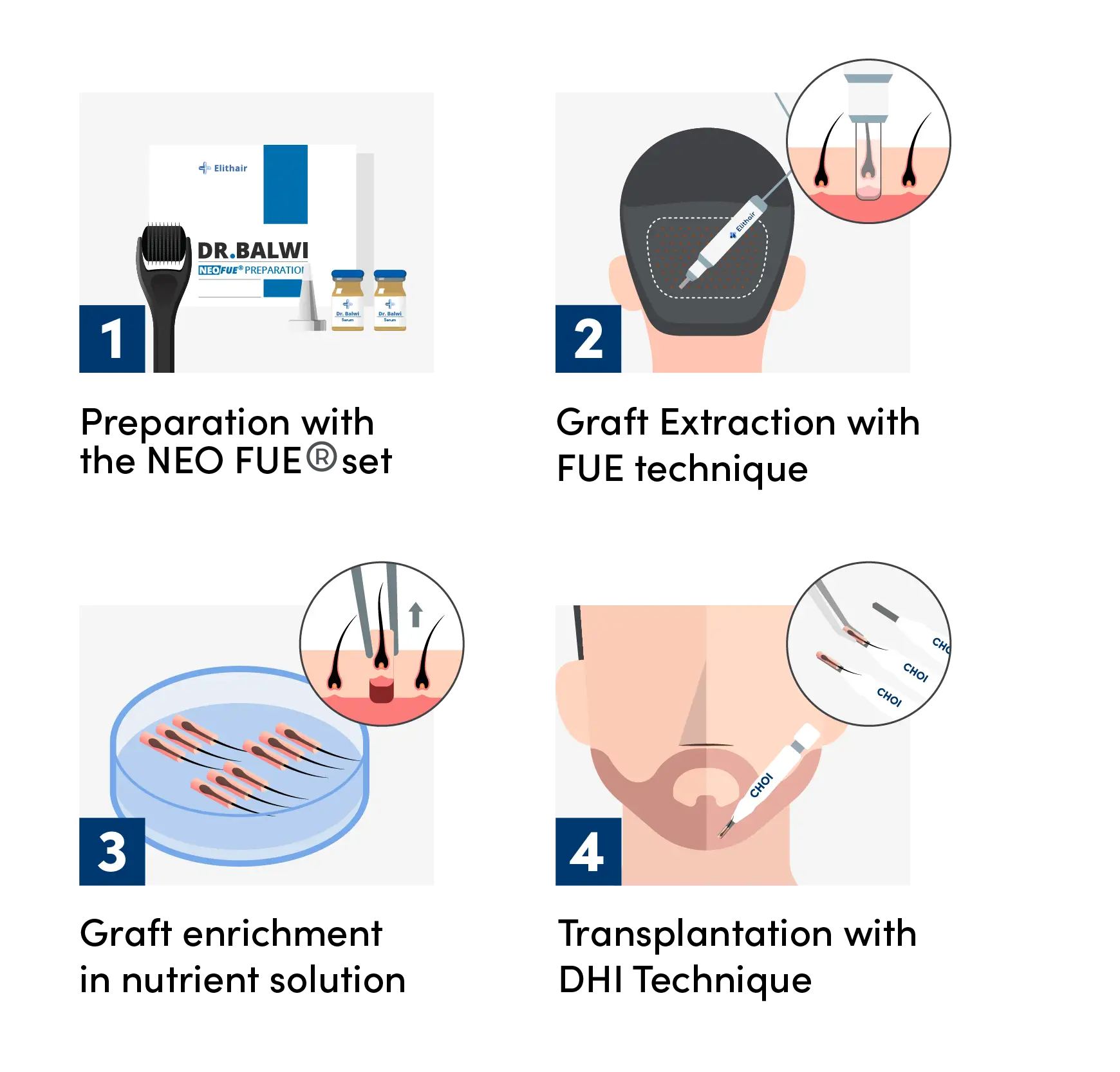 Infographic showing the 4 steps of the beard transplant with DHI Technic