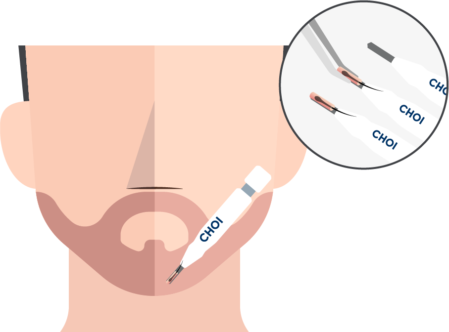 Illustration of graft insertion with the DHI technique for a beard transplant