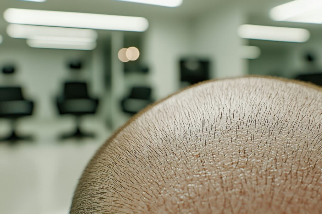 A close-up of a man's balding head. In the background we can see a clinic built to accommodate many patients.