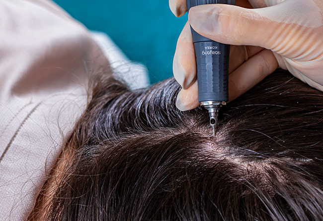 Motorised Extraction on Scalp – FUE Technique