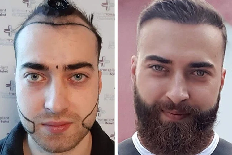 Before and after images of a hair and beard transplant patient at Elithair.