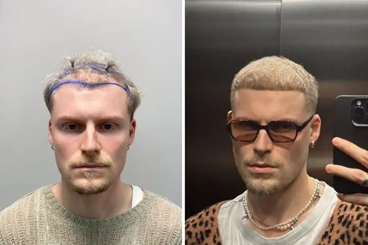 The before and after results of an Elithair hair transplant patient.