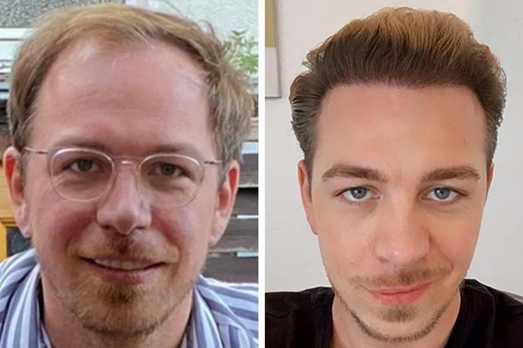Before and after images of an Elithair hair transplant patient.