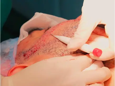 Elithair surgeon performing a beard transplant.