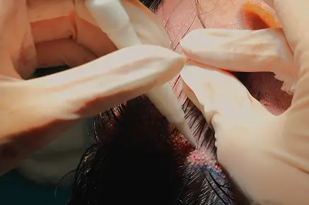 Close-up of a hair surgery procedure, showing a medical nurse with gloved hands implanting grafts.