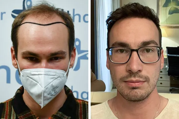 The before and after results of an Elithair hair transplant patient.