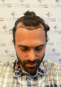 Man with tied hair looking down, showing his marked future hairline design before a hair transplant procedure.