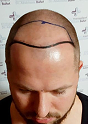 Man with shaved head looking down, showing a drawn hairline design before a hair transplant procedure.