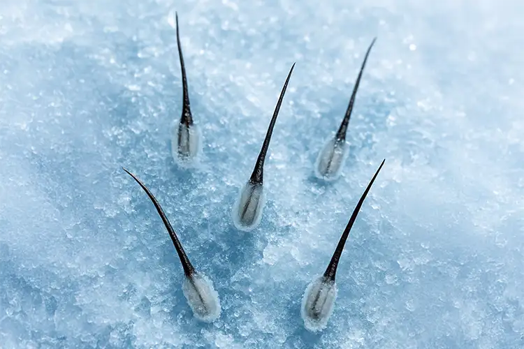 Extracted hair grafts rest on a bed of ice.