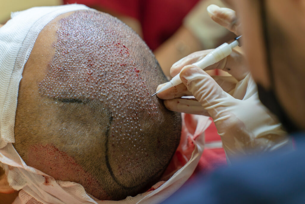 A patient receiving a DHI hair transplant.