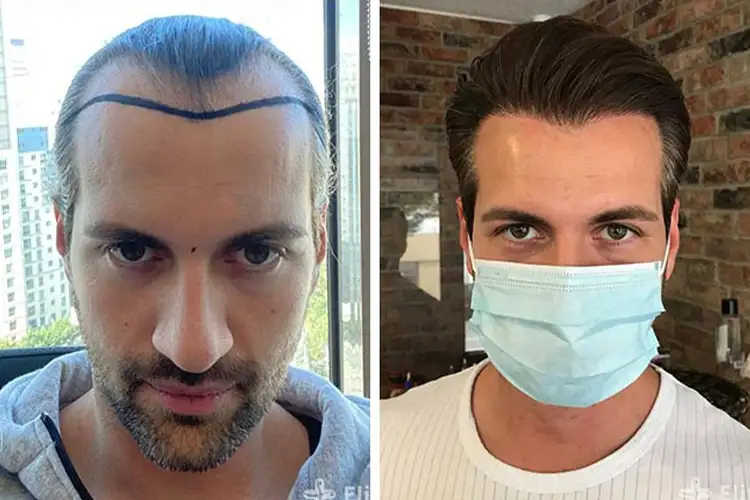 The before and after results of an Elithair hair transplant patient.