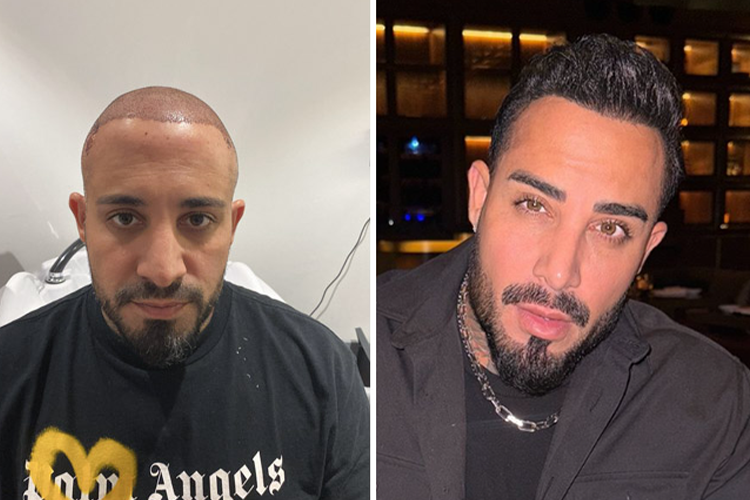 The before and after images of an Elithair hair transplant patient.