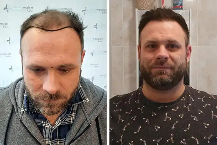 Before and after images of an Elithair hair transplant patient.