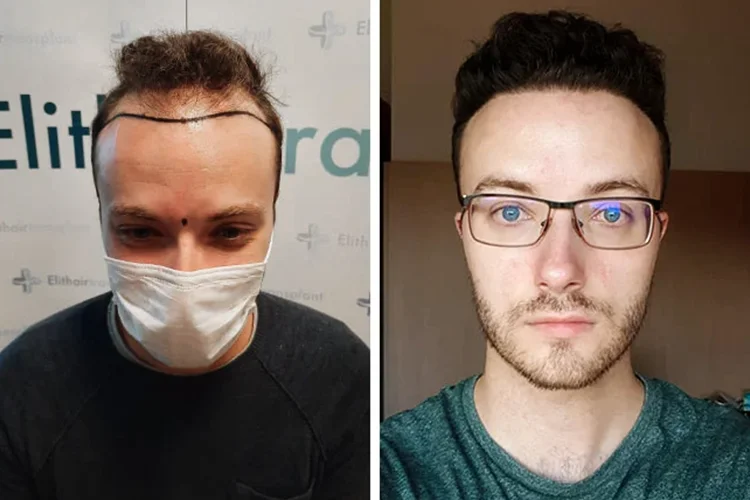 The before and after of an Elithair hair transplant patient.