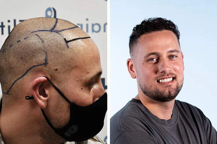 The before and after results of an Elithair hair transplant patient.