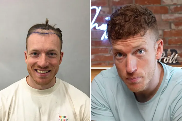 The before and after photos of an Elithair hair transplant patient.