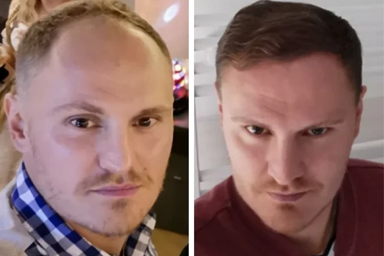 Before and after images of an Elithair hair transplant patient.