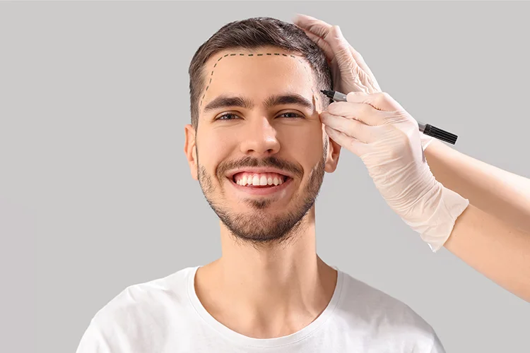 A man has his desired hairline drawn on before hair transplant surgery.