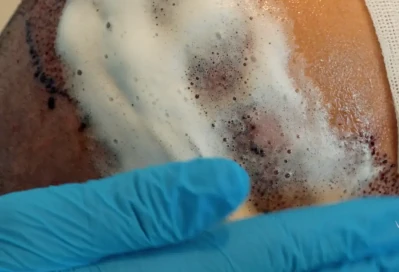 Pic shows a close-up of how the first hair wash after the hair transplant in Turkey is applied