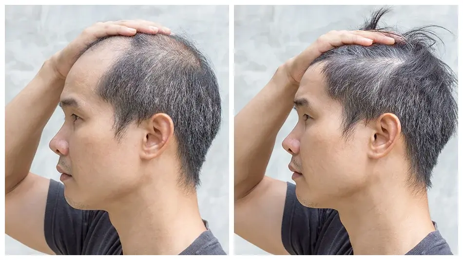 Two images of a South Korean man displaying different forms of hair loss.