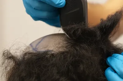 Pic shows a close-up shot of a patient getting his head shaved before the hair transplant in Turkey