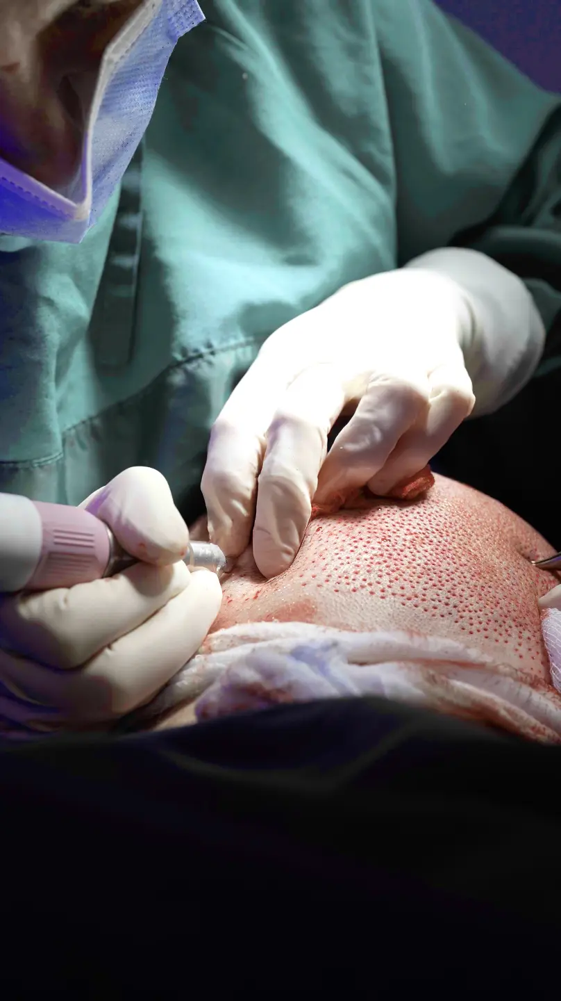 Pic shows a close-up of a Elithair specialist extracting grafts from the donor area of a patient with the FUE method.