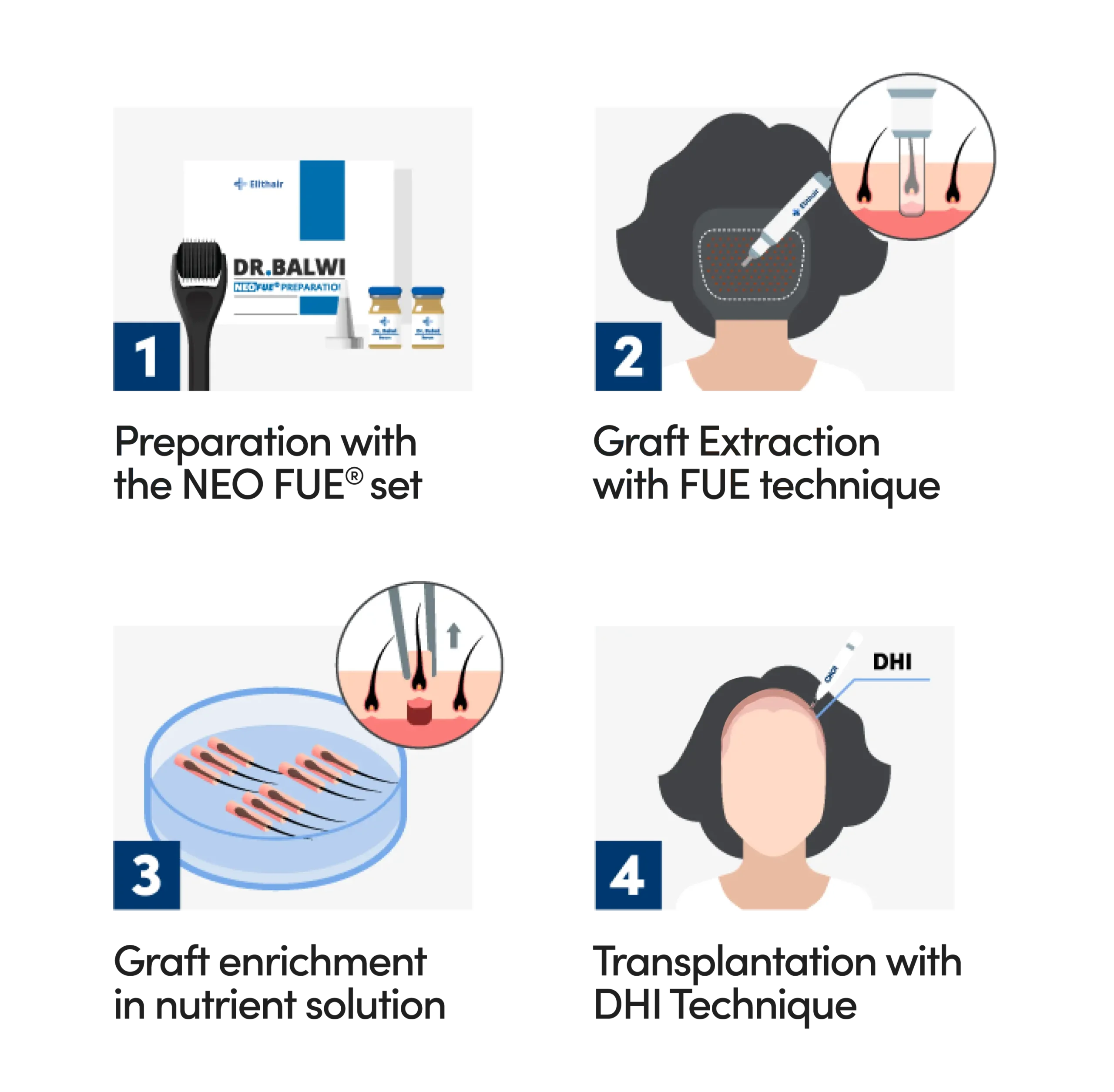 visual representation of the female hair transplant procedure using dhi method by elithair